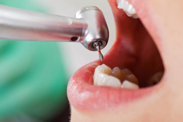 Best Emergency Root Canal Treatment in Farmville, NC